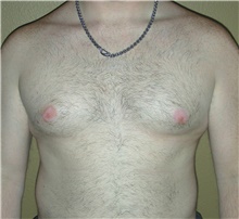 Male Breast Reduction Before Photo by Stanley Castor, MD; Tampa, FL - Case 39457