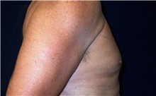Male Breast Reduction After Photo by Stanley Castor, MD; Tampa, FL - Case 39458