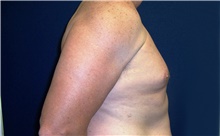 Male Breast Reduction Before Photo by Stanley Castor, MD; Tampa, FL - Case 39458
