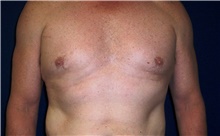 Male Breast Reduction After Photo by Stanley Castor, MD; Tampa, FL - Case 39458