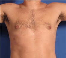 Male Breast Reduction After Photo by Stanley Castor, MD; Tampa, FL - Case 39459