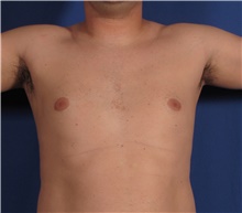 Male Breast Reduction Before Photo by Stanley Castor, MD; Tampa, FL - Case 39459