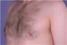 Male Breast Reduction After Photo by Stanley Castor, MD; Tampa, FL - Case 39460