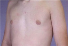 Male Breast Reduction After Photo by Stanley Castor, MD; Tampa, FL - Case 39461