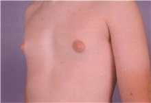 Male Breast Reduction Before Photo by Stanley Castor, MD; Tampa, FL - Case 39461