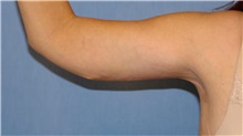 Arm Lift After Photo by Stanley Castor, MD; Tampa, FL - Case 39463