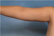 Arm Lift After Photo by Stanley Castor, MD; Tampa, FL - Case 39465