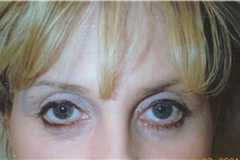 Eyelid Surgery After Photo by Stanley Castor, MD; Tampa, FL - Case 39470
