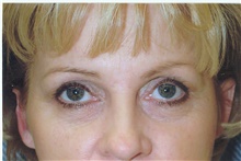 Eyelid Surgery Before Photo by Stanley Castor, MD; Tampa, FL - Case 39470