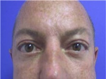 Eyelid Surgery After Photo by Stanley Castor, MD; Tampa, FL - Case 39471