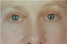 Eyelid Surgery After Photo by Stanley Castor, MD; Tampa, FL - Case 39472