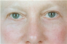 Eyelid Surgery Before Photo by Stanley Castor, MD; Tampa, FL - Case 39472