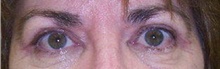 Eyelid Surgery After Photo by Stanley Castor, MD; Tampa, FL - Case 39473
