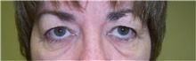 Eyelid Surgery Before Photo by Stanley Castor, MD; Tampa, FL - Case 39473