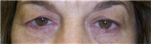Eyelid Surgery Before Photo by Stanley Castor, MD; Tampa, FL - Case 39474