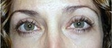 Eyelid Surgery After Photo by Stanley Castor, MD; Tampa, FL - Case 39475