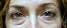 Eyelid Surgery Before Photo by Stanley Castor, MD; Tampa, FL - Case 39475