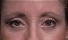 Eyelid Surgery After Photo by Stanley Castor, MD; Tampa, FL - Case 39476