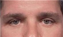 Eyelid Surgery After Photo by Stanley Castor, MD; Tampa, FL - Case 39477