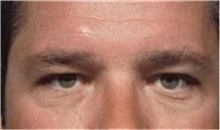 Eyelid Surgery Before Photo by Stanley Castor, MD; Tampa, FL - Case 39477