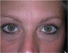 Eyelid Surgery Before Photo by Stanley Castor, MD; Tampa, FL - Case 39478