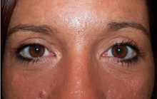 Eyelid Surgery After Photo by Stanley Castor, MD; Tampa, FL - Case 39479