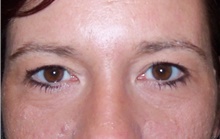 Eyelid Surgery Before Photo by Stanley Castor, MD; Tampa, FL - Case 39479