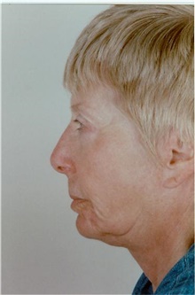 Facelift Before Photo by Stanley Castor, MD; Tampa, FL - Case 39481