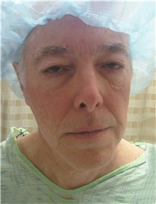 Facelift Before Photo by Stanley Castor, MD; Tampa, FL - Case 39482