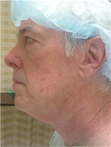 Facelift Before Photo by Stanley Castor, MD; Tampa, FL - Case 39482