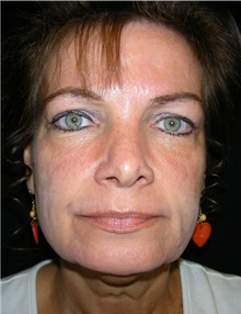 Facelift Before Photo by Stanley Castor, MD; Tampa, FL - Case 39483