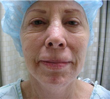 Facelift Before Photo by Stanley Castor, MD; Tampa, FL - Case 39486