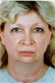 Facelift Before Photo by Stanley Castor, MD; Tampa, FL - Case 39487