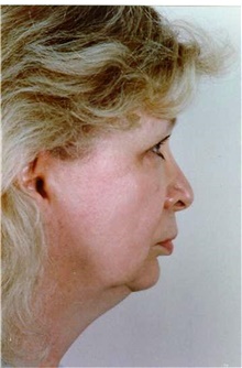 Facelift Before Photo by Stanley Castor, MD; Tampa, FL - Case 39487