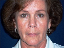 Facelift Before Photo by Stanley Castor, MD; Tampa, FL - Case 39488