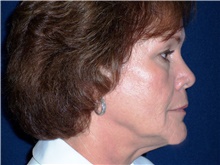 Facelift Before Photo by Stanley Castor, MD; Tampa, FL - Case 39488