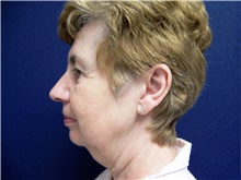 Facelift Before Photo by Stanley Castor, MD; Tampa, FL - Case 39489