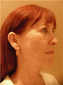 Facelift Before Photo by Stanley Castor, MD; Tampa, FL - Case 39490