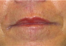 Injectable Fillers After Photo by Stanley Castor, MD; Tampa, FL - Case 39499