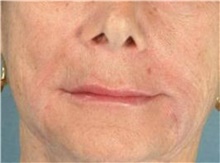 Injectable Fillers After Photo by Stanley Castor, MD; Tampa, FL - Case 39500