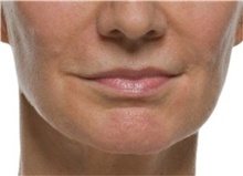 Injectable Fillers After Photo by Stanley Castor, MD; Tampa, FL - Case 39504