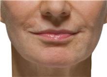 Injectable Fillers Before Photo by Stanley Castor, MD; Tampa, FL - Case 39504