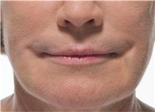 Injectable Fillers After Photo by Stanley Castor, MD; Tampa, FL - Case 39507