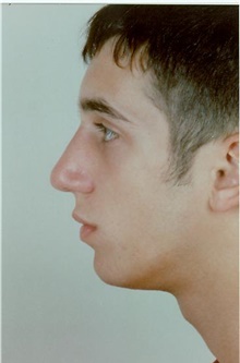 Rhinoplasty After Photo by Stanley Castor, MD; Tampa, FL - Case 39510