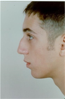 Rhinoplasty Before Photo by Stanley Castor, MD; Tampa, FL - Case 39510