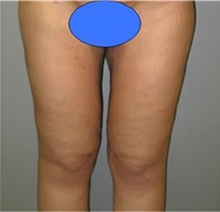 Thigh Lift After Photo by Stanley Castor, MD; Tampa, FL - Case 39515