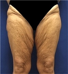 Thigh Lift Before Photo by Stanley Castor, MD; Tampa, FL - Case 39516