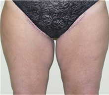 Thigh Lift After Photo by Stanley Castor, MD; Tampa, FL - Case 39518