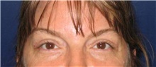 Brow Lift After Photo by Stanley Castor, MD; Tampa, FL - Case 39523