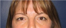 Brow Lift Before Photo by Stanley Castor, MD; Tampa, FL - Case 39523